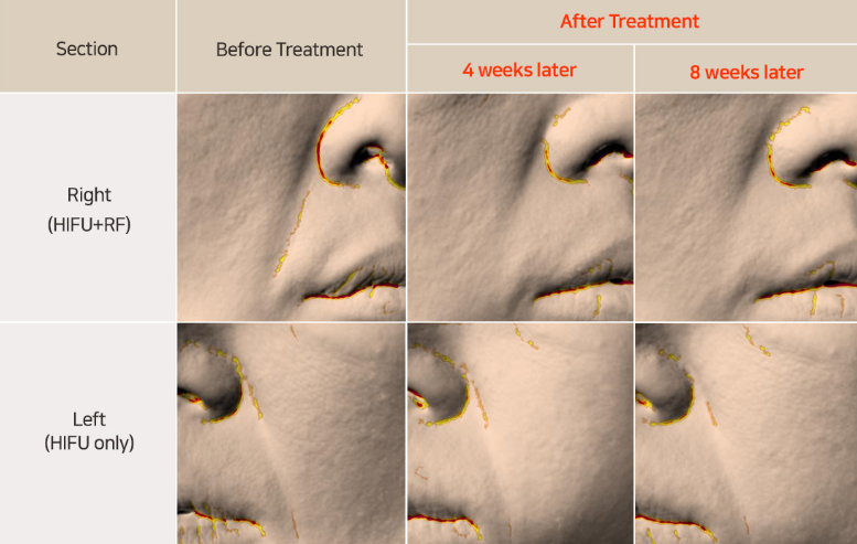 improvement in smile lines